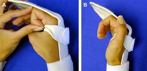 Therapy after Flexor Tendon Repair - Hand Clinics