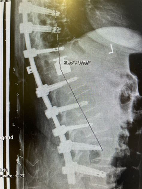 77-year-old patient in condition after a fall 4 weeks ago and first ...