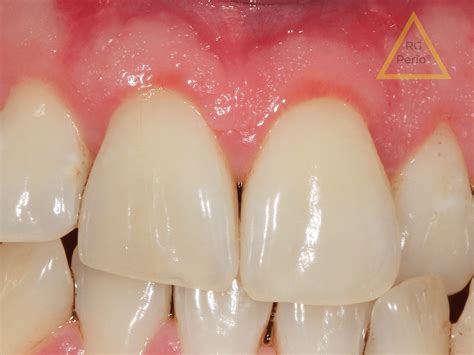 Aesthetic Gum Recession Surgery – Holland Park Dental