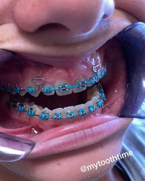 Invisalign Buttons 的图像结果