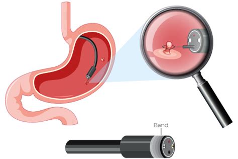 Endoscopy Plus Banding in Dwarka,Delhi | Dr. Gaurav Maurya