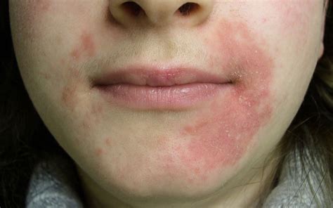 Perioral Dermatitis: Cure, Signs, Risks & Everything You Need To Know ...