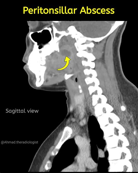 Peritonsillar Abscess X Ray