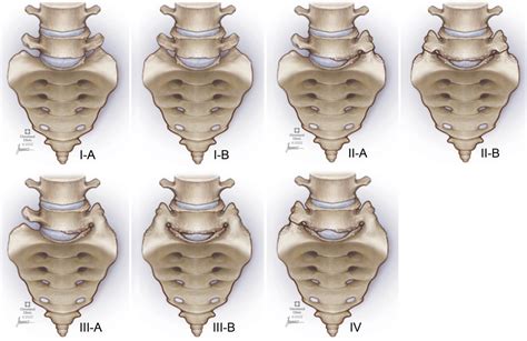 Examining degenerative disease adjacent to lumbosacral transitional ...