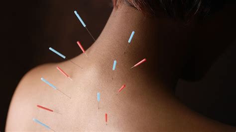How Acupuncture Therapy Eases Pain