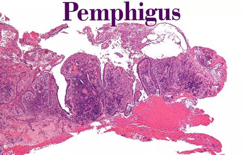 Presence of ARAs no contraindication to reinfusion of rituximab in ...