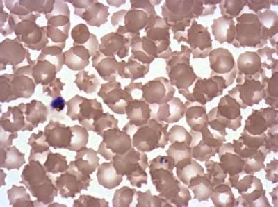 Plasmodium Falciparum from Images of Giemsa for Malaria Detection ...