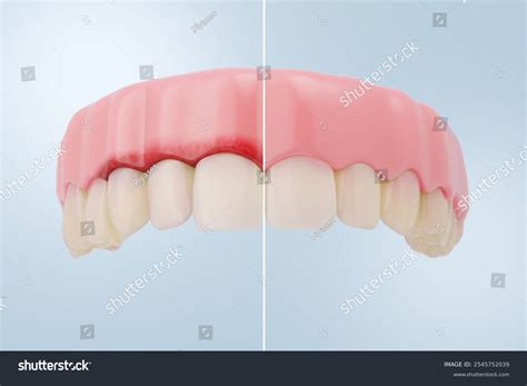 Comparison Healthy Gums Vs Gingivitis Detailed Stock Illustration 2545752039 | Shutterstock