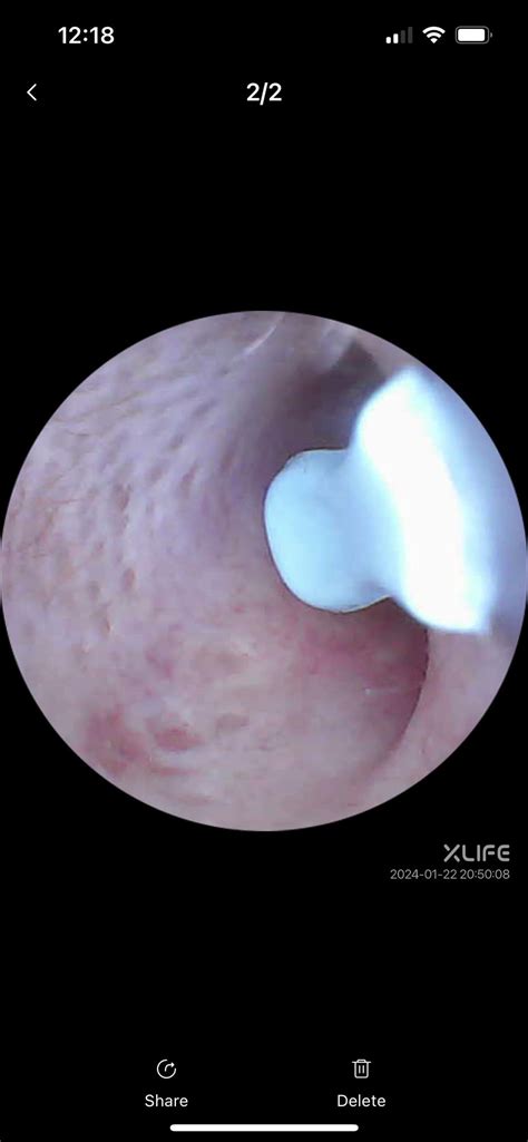 The skin on the inside of my ear canals looks like this, is it normal ...