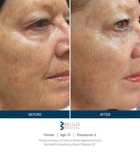 Microneedling with PRP (Platelet Rich Plasma) - Tribeca Skin Center