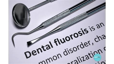 How to Treat Fluorosis Teeth: A Comprehensive Guide 🦷💧