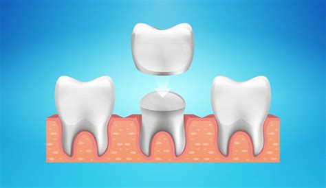 Dental Crowns and Bridges - Laxmi Dental Care