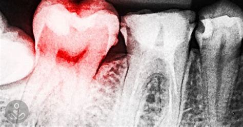 Image result for Abscessed Tooth Explosion