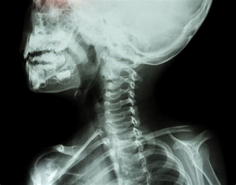 Image result for Neck X-Ray