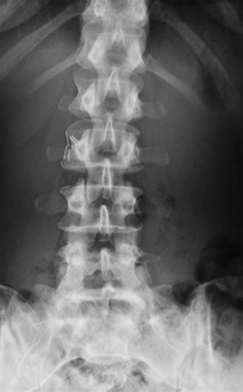 A reliable measurement for identifying a lumbosacral transitional ...