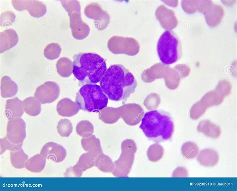 Leucemia mieloide aguda foto de stock. Imagem de hematologia - 99238910