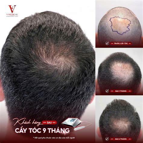 các kiểu tóc cho người bị hói chữ m | Vmedicalclinic.vn