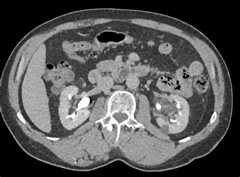 Kuvatulokset haulle parapelvic cyst kidney
