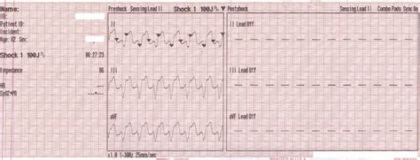 Image result for Synchronized Cardioversion Doses