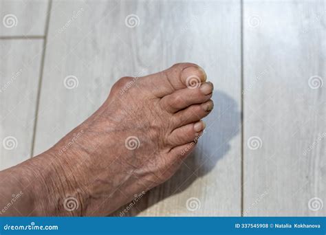 An Old Woman& X27;s Leg. a Foot with Unkempt Long Nails and a Sore Big Toe Joint Stock Photo ...