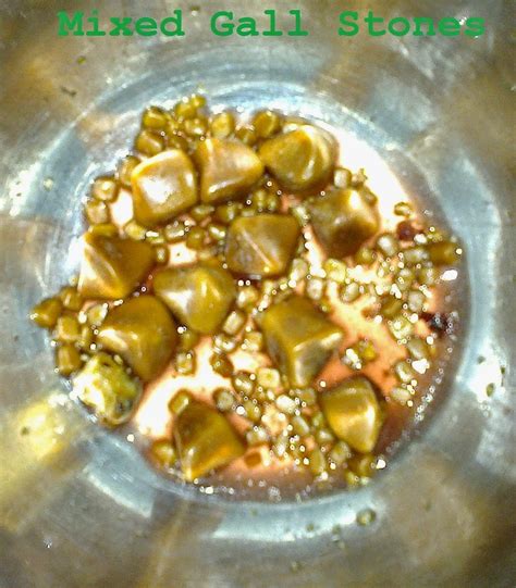 Introduction of Gallbladder Stones (Cholelithiasis) « General Surgical Operations