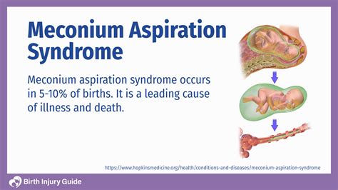 Meconium Aspiration Syndrome Meconium Stained Amniotic Fluid