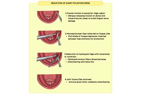 Alveolar Ridge Correction in Pre-Prosthetic Surgery: Methods, Indicati ...