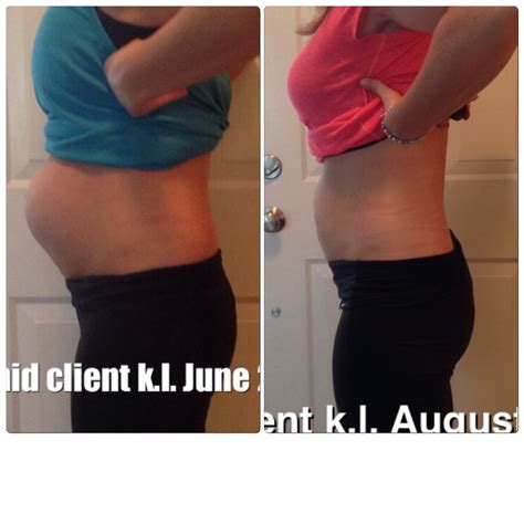 All New Before and After Pictures – Healing the Diastasis Recti 2015 – Beautiful After the Belly