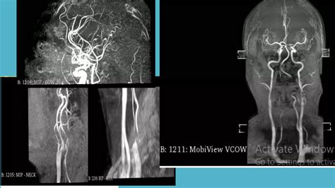 Magnetic Resonance Angiography and Venography | PPTX