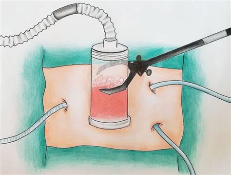 Image result for Intraperitoneal Therapy