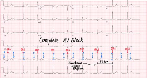 Junctional Escape Beats: Evaluating the Underlying Problem