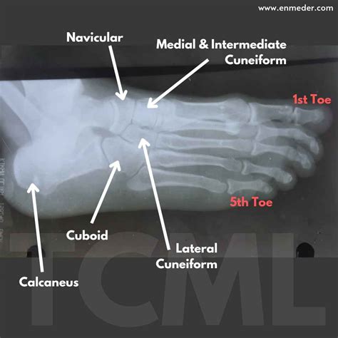 Tarsal bone - TCML - The Charsi of Medical Literature