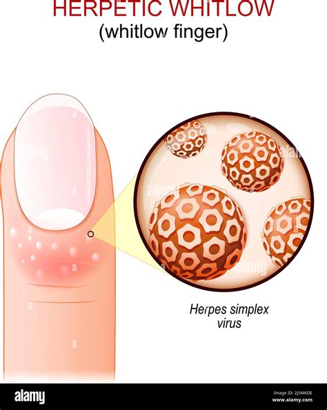 Herpes Whitlow Virus