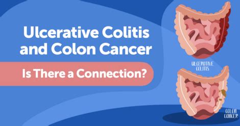 Colitis Vs. Cancer 的图像结果