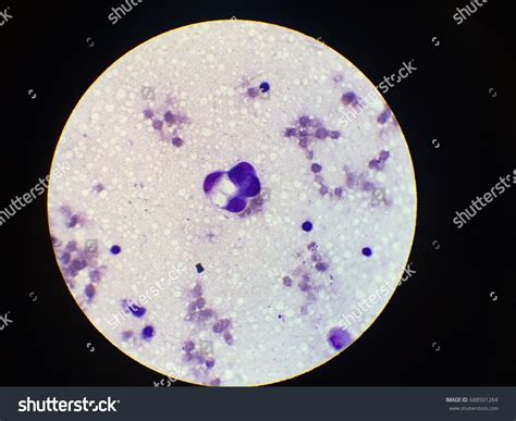 2+ Hundred Signet Ring Cell Royalty-Free Images, Stock Photos & Pictures | Shutterstock