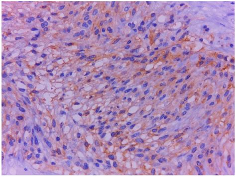 Duodenal Ampulla Neuroendocrine Tumor with GISTs of the Proximal ...