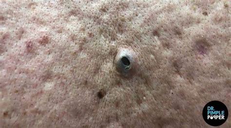 Image result for Exploding Pimple On Bottom
