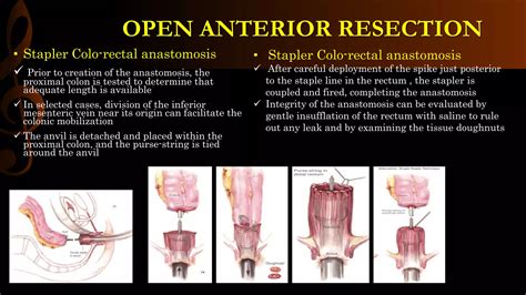 Image result for Apr Resection Surgery