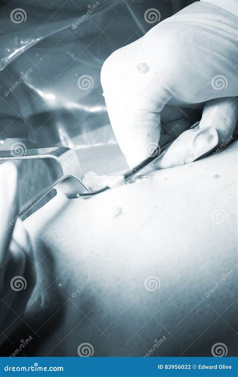 Surgical Operation Knee Surgery Stock Photo - Image of knees, incision: 83956022