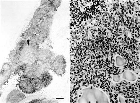 Image result for What Is Thymic Involution