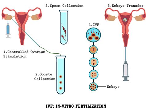 IVF Procedure Explained 的图像结果