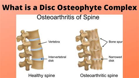 What is a Disc Osteophyte Complex - YouTube