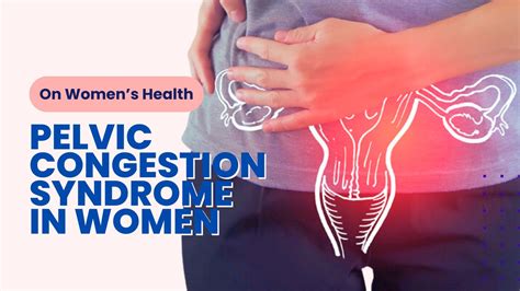 Pelvic Congestion Syndrome in Women: 10 Questions Answered