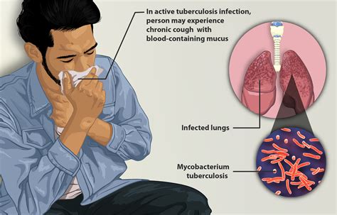 Health risks and tuberculosis — lesson. Science State Board, Class 7.