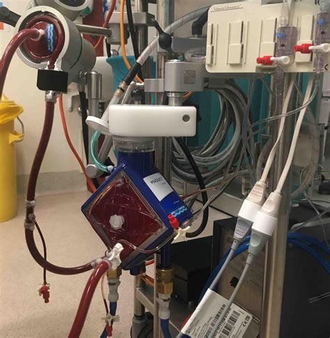 Image result for ECMO Procedure