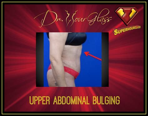 Bulge In Upper Abdomen