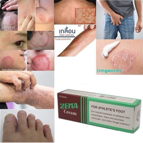 Zema Cream for Dermatitis, Tinea, Eczema, Ringworm & India | Ubuy