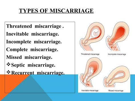 What Is A Threatened Miscarriage