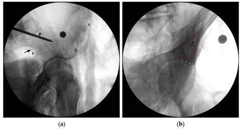 Overlegen Gluteal Nerveinnervasjon