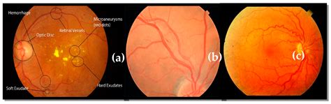 Retinal Hemorrhage Hypertension Hypertensive Retinopathy Associated